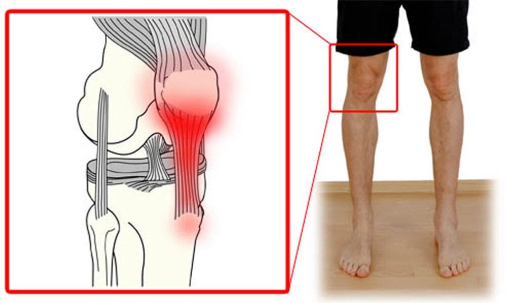 Tendinite - inflamación dos tendóns da articulación do xeonllo
